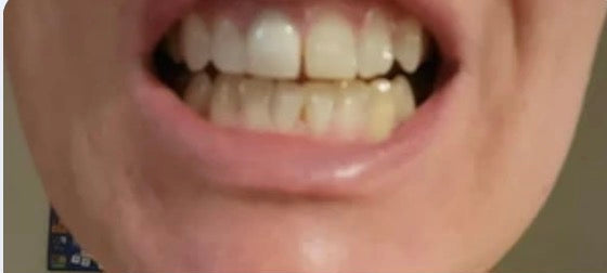 Hannah T. before